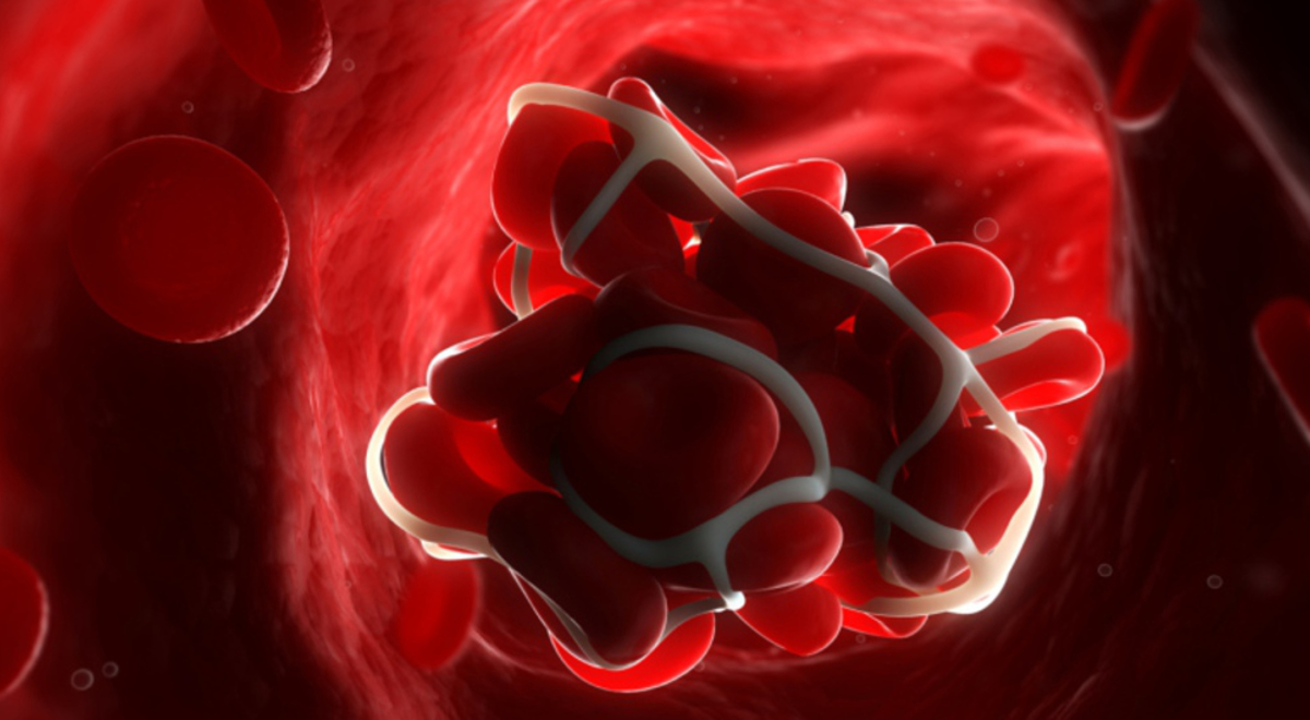 A computerised render of a blood clot in the bloodstream